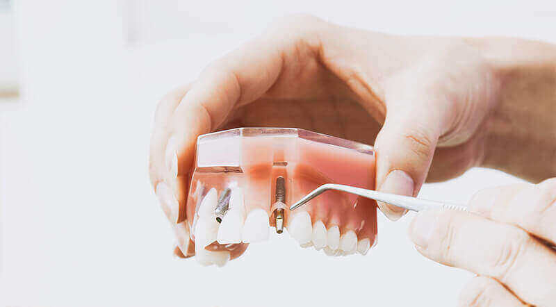 Implant Dentar Buzau