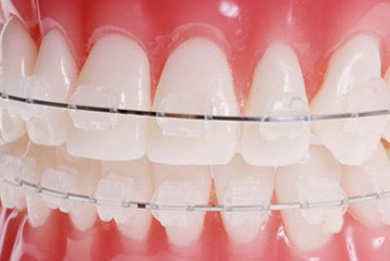 aparat dentar ceramic