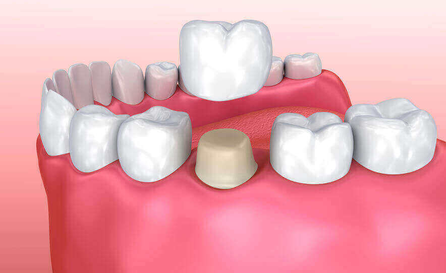 coroanele dentare Protetica dentara Buzau coroanele dentare Protetica dentara Buzau