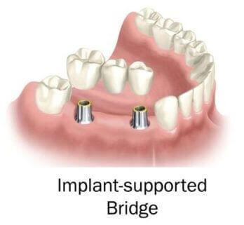 Puntea dentara implanturi Protetica dentara Buzau